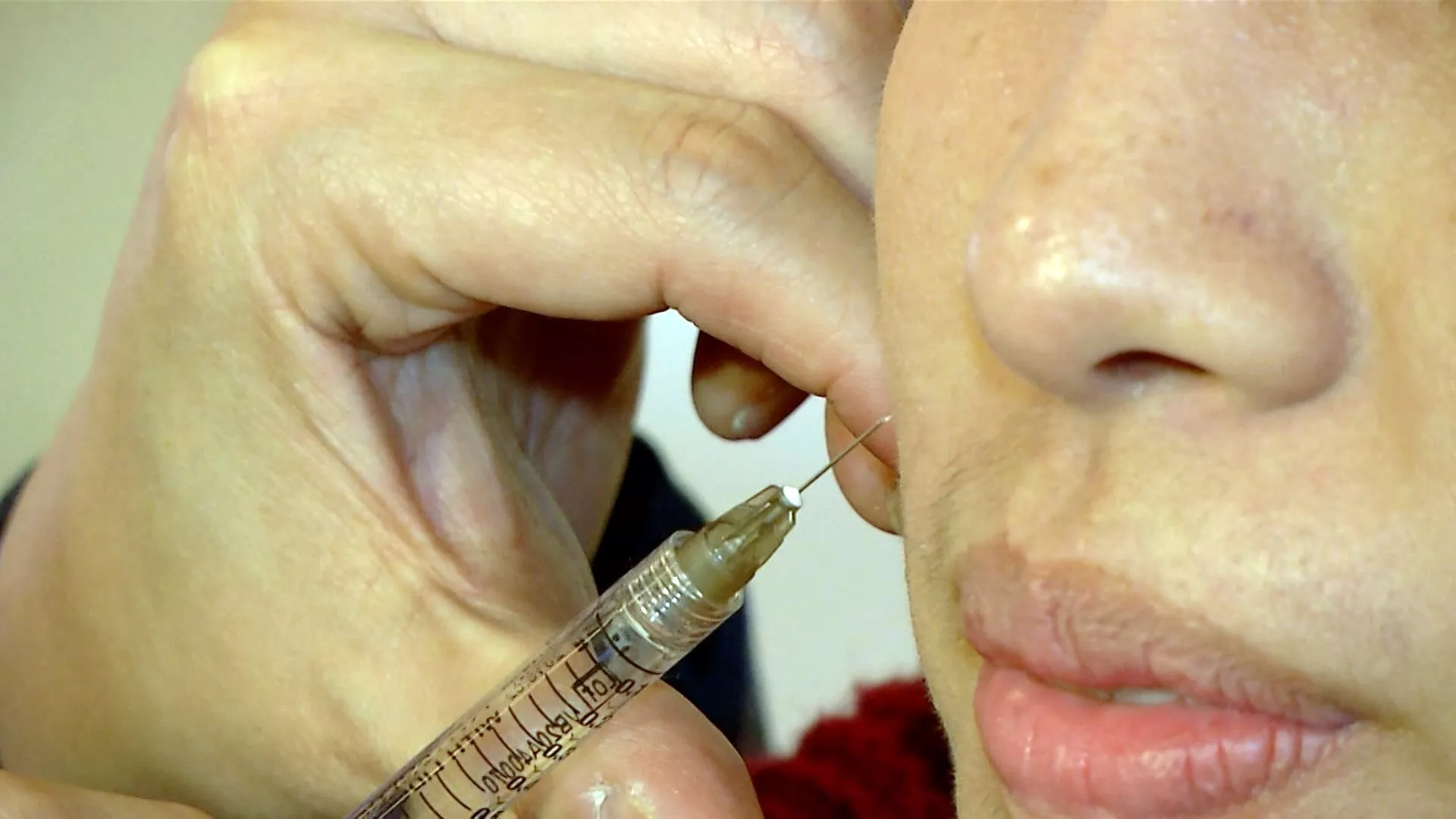 Ngộ độc suýt chết vì sử dụng kim tiêm thẩm mỹ trôi nổi trên mạng