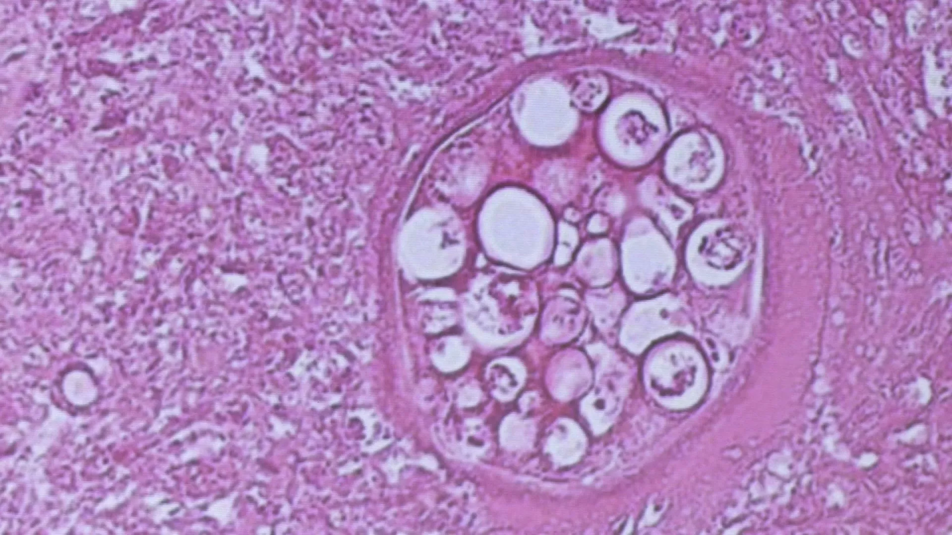 พบผู้ติดเชื้อ Coccidioidomycosis ในไต้หวันรายแรก เป็นชายวัย 50 ปี
