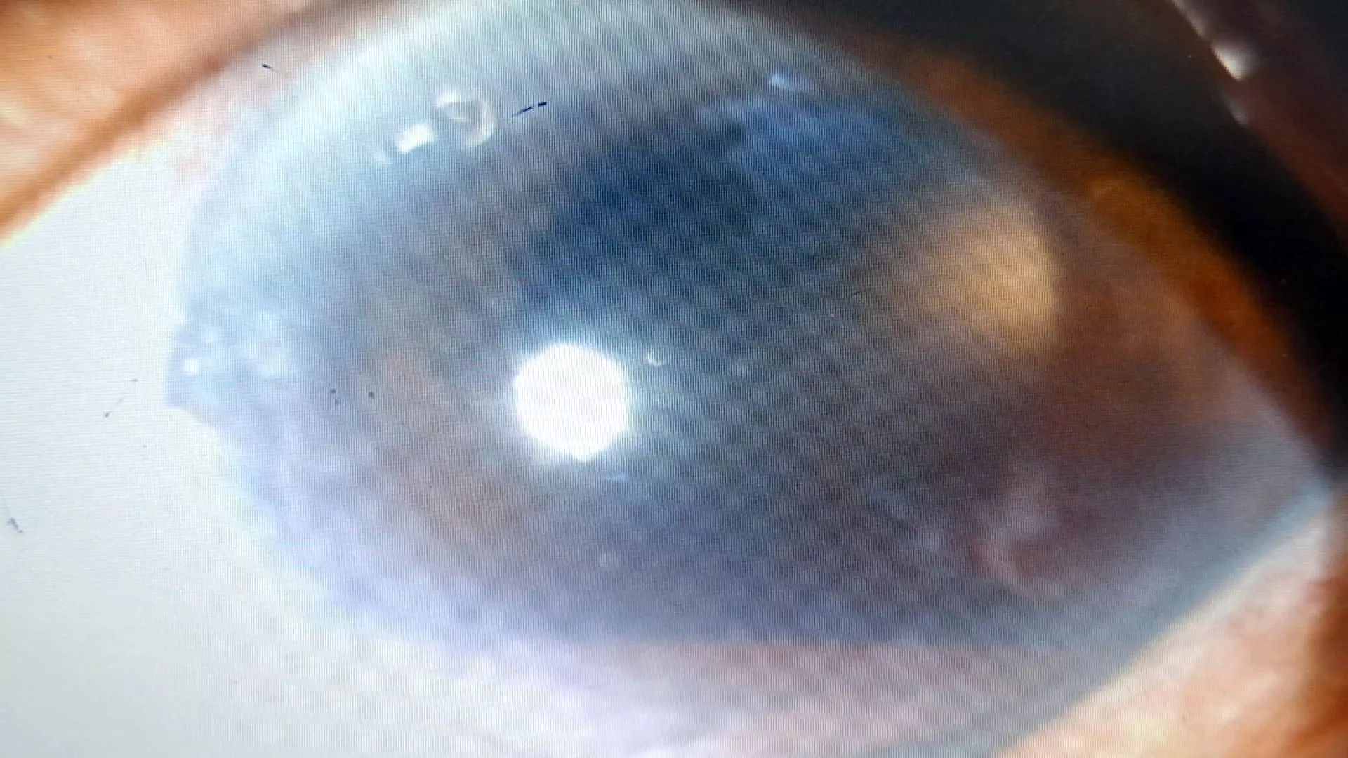 ชายใช้ปากกาลดน้ำหนัก 2 เดือน ตาซ้ายเลือดออกเกือบตาบอดสนิท