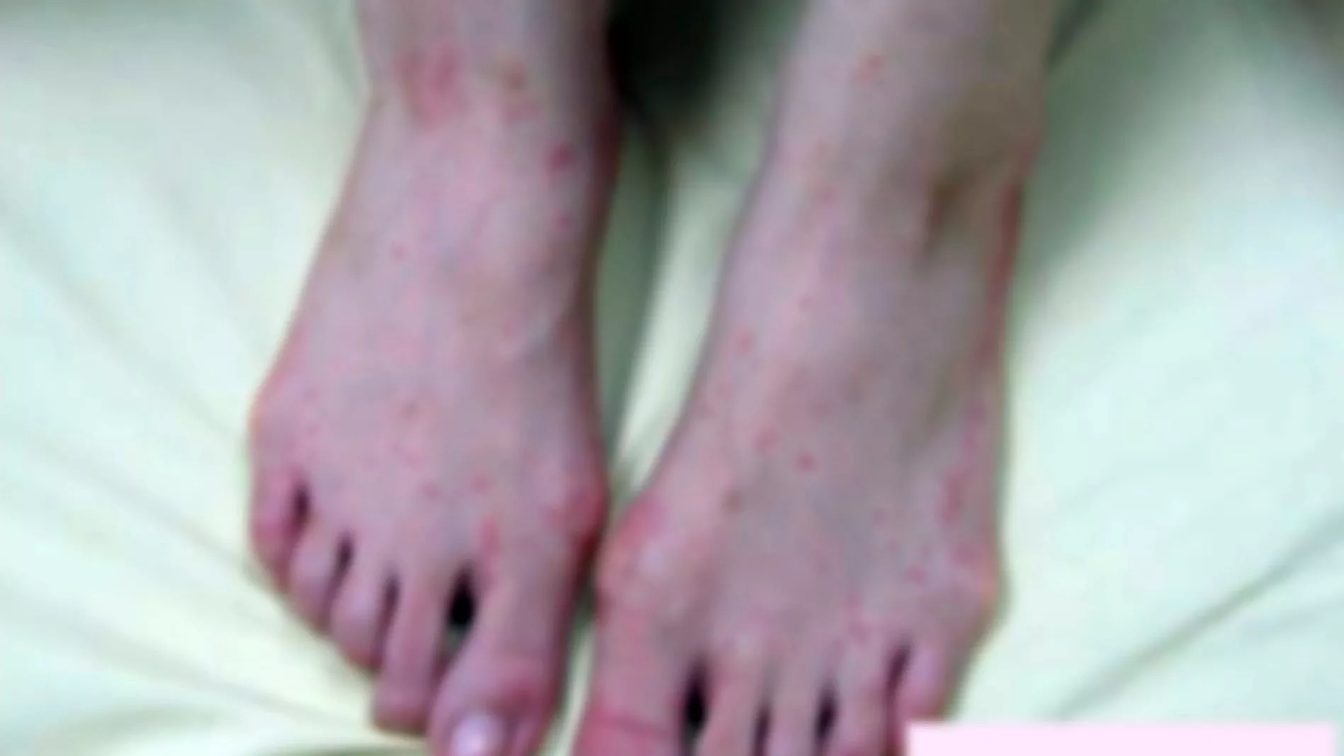 Ca sởi "không triệu chứng điển hình" gây khó khăn khi chẩn đoán