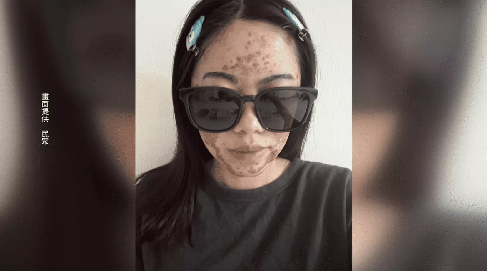 欲變媠煞險險仔毀容 診所用過期水果酸化妝品