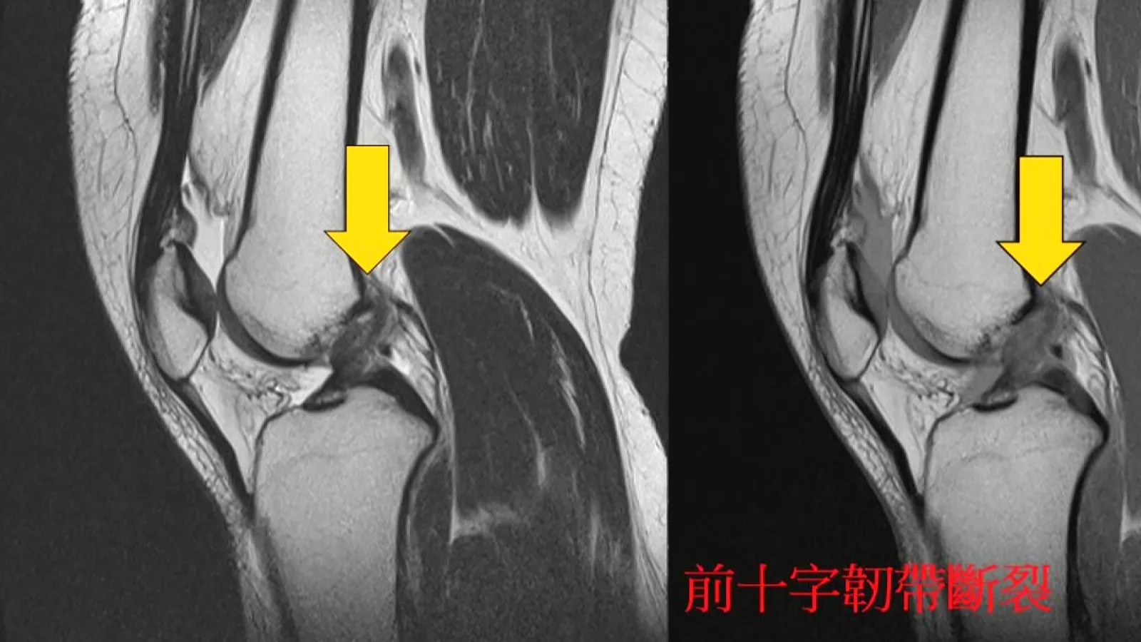 十字韌帶重建手術搭高壓氧治療 術後恢復期可縮短至半年